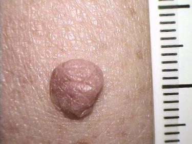 FIGURE 12-5, Compound melanocytic nevus. A brown nodule is present.