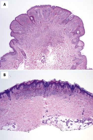 FIGURE 12-6, Silhouette of an ordinary melanocytic nevus. A, Symmetric silhouette of an ordinary polypoid melanocytic nevus. B, Symmetric silhouette of an ordinary plaquelike melanocytic nevus.