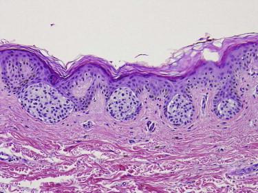 FIGURE 12-7, Junctional melanocytic nevus. Nests of melanocytes are present at the dermal-epidermal junction.