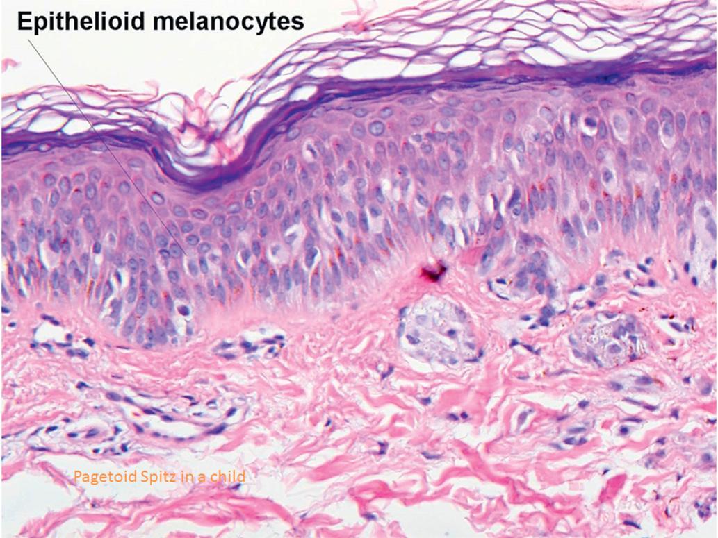 Fig. 6.11, Pagetoid intraepidermal Spitz nevus