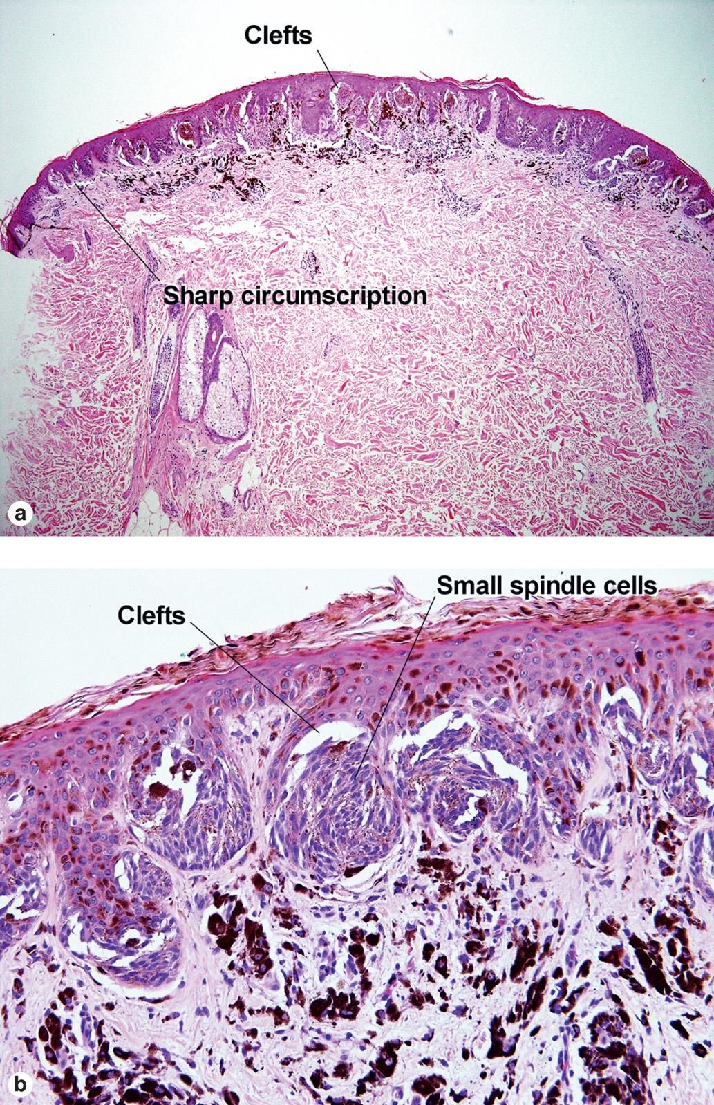 Fig. 6.12, Pigmented spindle cell nevus