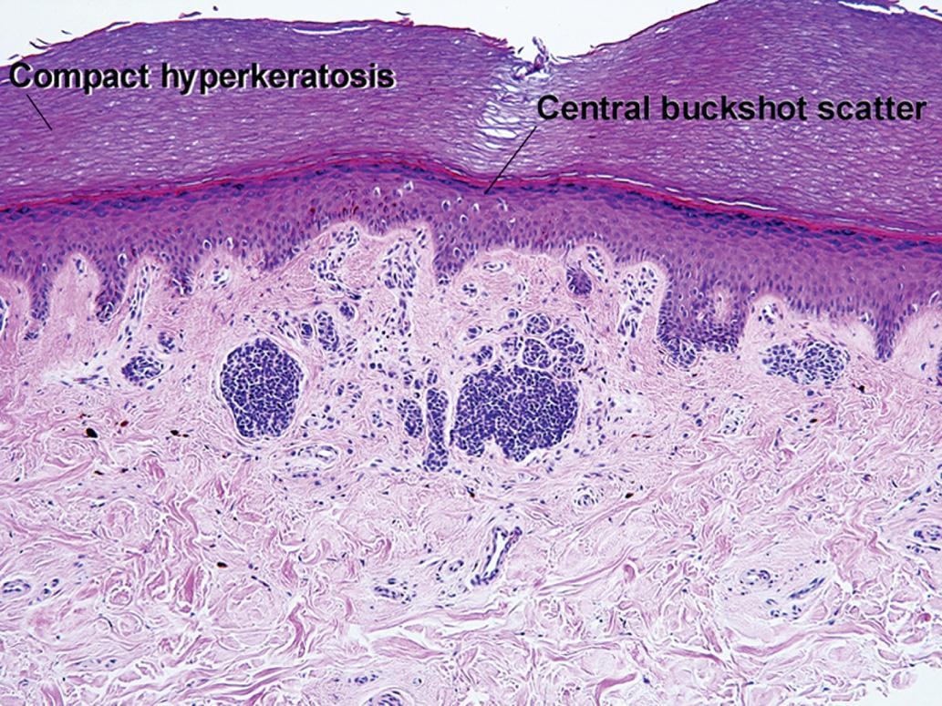 Fig. 6.14, Acral nevus