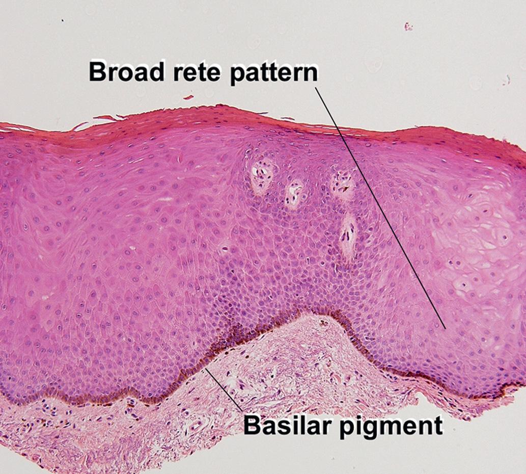 Fig. 6.2, Melanotic macule