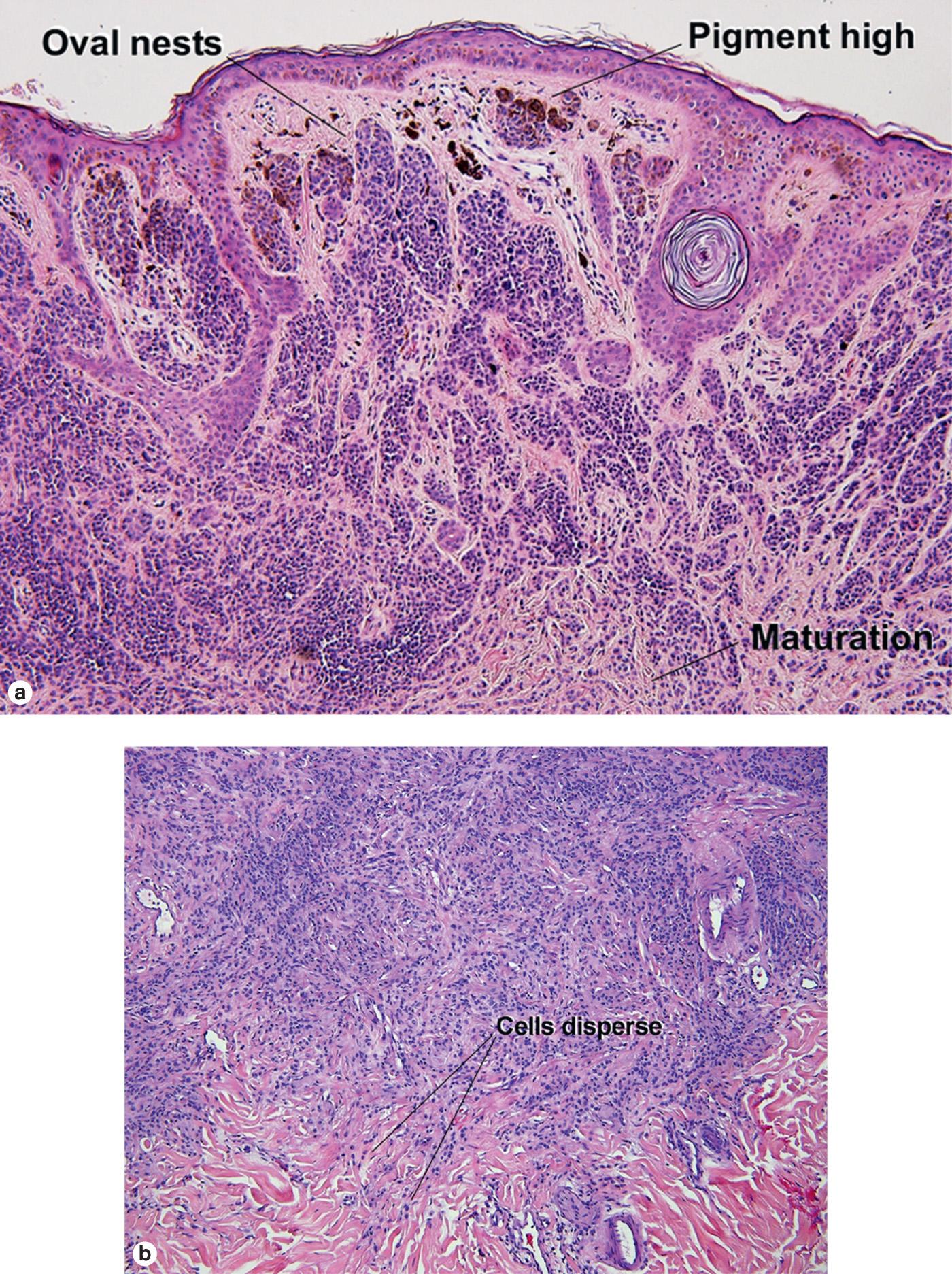 Fig. 6.3, Benign melanocytic nevus. (F and G) Preservation of delicate elastic fibers is typically noted throughout the lesion. See Fig. 6.29 (J) for comparison with melanoma. (H) Conjunctival nevi characteristically demonstrate complex epithelial crypts. See Fig. 6.29 (L) for comparison with conjunctival melanoma