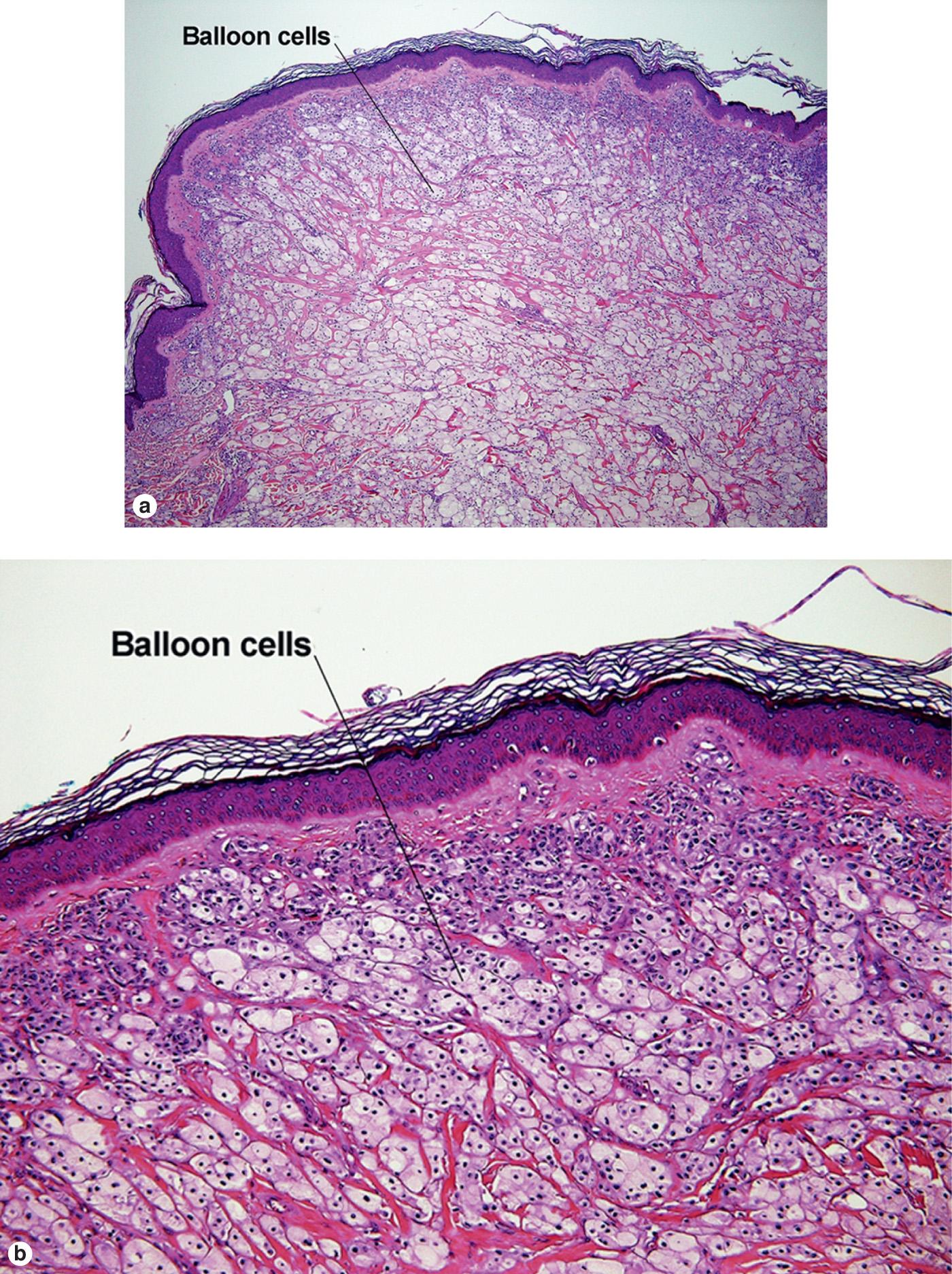 Fig. 6.4, Balloon cell nevus