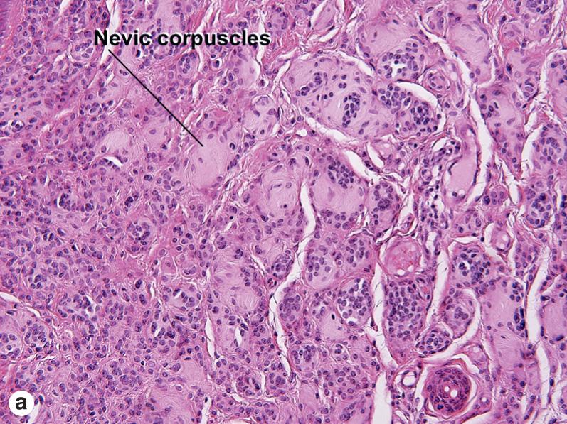 Fig. 6.5, Neural nevus