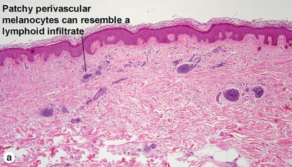 Fig. 6.6, Congenital nevus