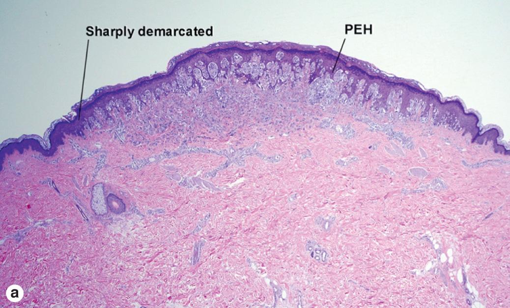 Fig. 6.7, Spitz nevus ( PEH, pseudoepitheliomatous hyperplasia)