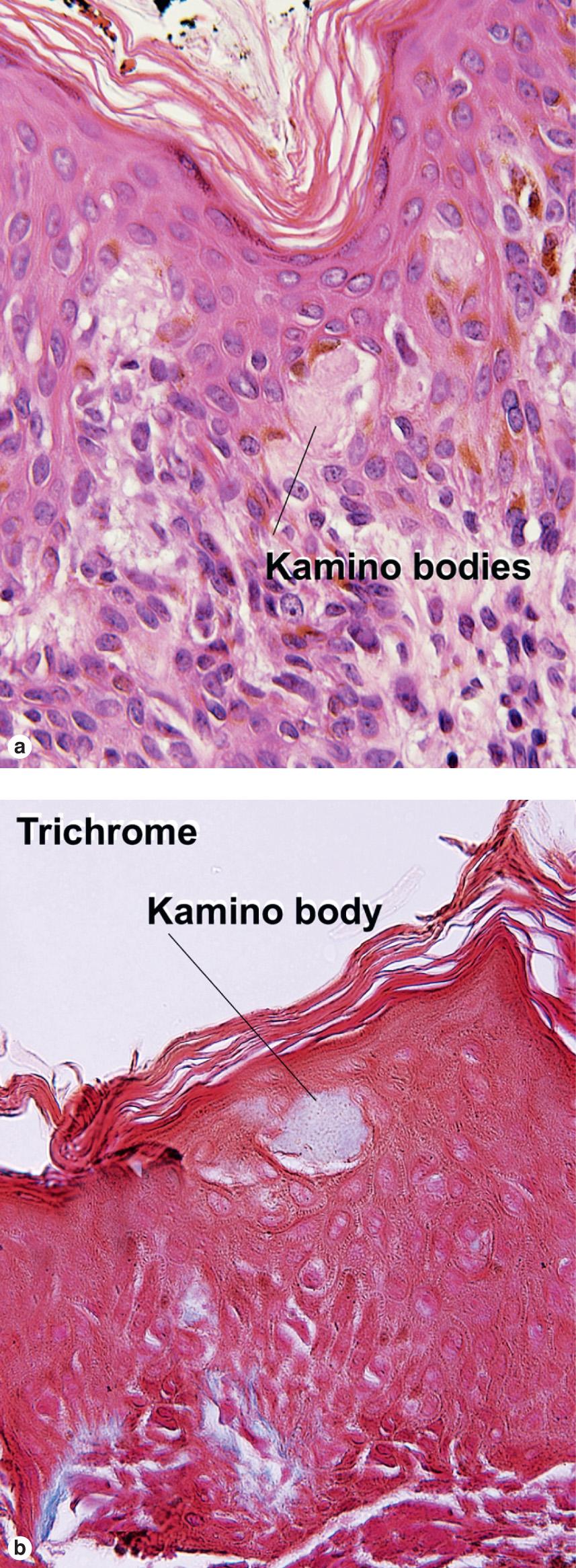 Fig. 6.8, Kamino body (trichrome stain)