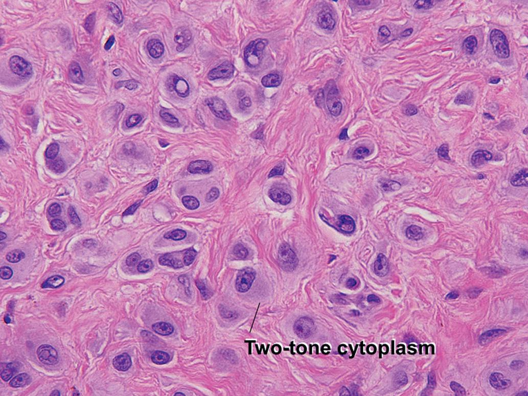 Fig. 6.10, Intradermal Spitz nevus