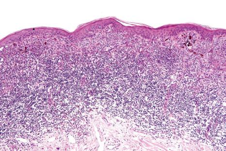 Fig. 25.101, Halo nevus: there are residual junctional nests deep to which is a dense, bandlike lymphohistiocytic infiltrate.