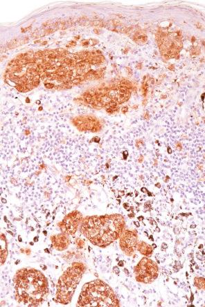 Fig. 25.104, Halo nevus: S100 protein immunohistochemistry highlights the residual nests in the dermis.