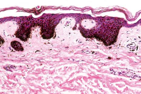 Fig. 25.16, Ink spot lentigo: there is massive basal cell hyperpigmentation.