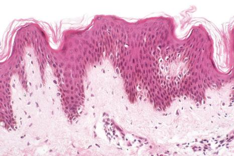 Fig. 25.19, Becker nevus: there is mild acanthosis and increased numbers of basal melanocytes are present. In addition, there is obvious hyperpigmentation, but no junctional activity.