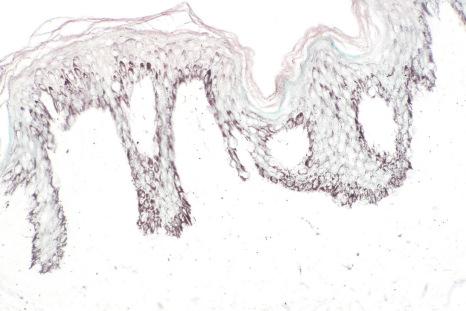 Fig. 25.20, Becker nevus: the increased pigmentation may be accentuated by the Masson-Fontana reaction.