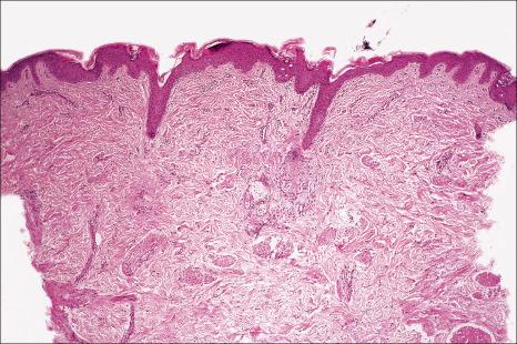 Fig. 25.21, Becker nevus: in this example, hamartomatous aggregates of smooth muscle cells are widely distributed throughout the dermis.