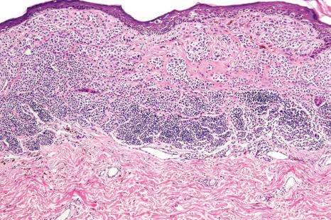 Fig. 25.23, Melanoma: this lesion has arisen within a pre-existent compound melanocytic nevus. The residual benign component is present in the lower field. Compare the pleomorphism of the melanoma with the uniform nevus population.