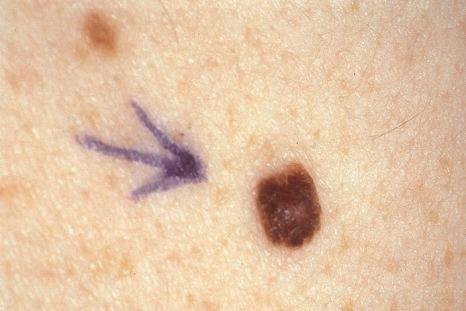 Fig. 25.28, Compound nevus: the nevus has a central raised dome-shaped component. Color is uniform, and the margin is sharply defined.