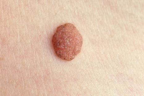 Fig. 25.30, Dermal melanocytic nevus: presentation as a pale, raised, dermal warty, nodule is a common finding.