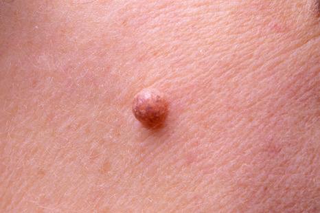 Fig. 25.31, Dermal melanocytic nevus: this example presents a dome-shaped appearance. There is focal residual pigmentation.