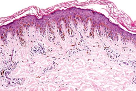 Fig. 25.32, Lentiginous junctional nevus: note the marked elongation of the rete ridges. The junctional nests are present at their tips, a characteristic location in banal nevi.