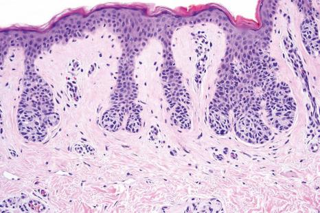 Fig. 25.34, Junctional nevus: in this example, the nests of melanocytes are located at the tips of the rete ridges (compare with dysplastic nevi in which nests are often seen along the sides of the rete and overlying the tips of the dermal papillae).