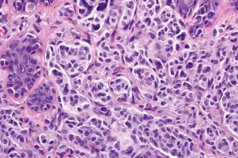 Fig. 25.35, Type A nevus cells: the cytoplasm is pale staining, and nuclei are vesicular and uniform. Nucleoli when visible are typically small.