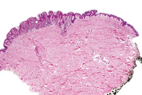 Fig. 25.37, Compound nevus: lesions often have a verrucous or warty appearance.