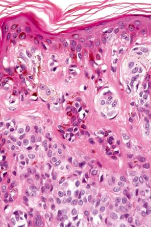 Fig. 25.39, Compound nevus: high-power view of type A nevus cells. The nuclei are uniform and many contain small nucleoli.