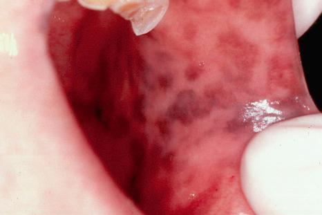 Fig. 25.4, Laugier-Hunziker syndrome: oral melanotic macules.