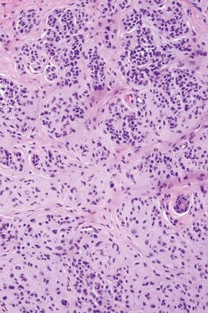 Fig. 25.42, Dermal nevus: the darkly staining superficial nevus cells are type B cells. In the deeper reaches, spindled forms are evident, a feature of maturation.