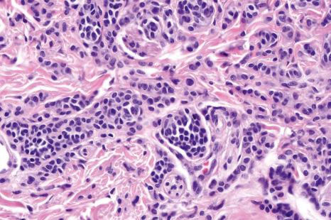 Fig. 25.43, Dermal nevus: type B cells have uniform hyperchromatic nuclei with little cytoplasm.