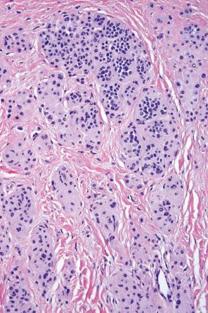 Fig. 25.45, Dermal nevus: this view shows maturation with spindle-shaped type C cells at the base. Nuclei at the top of the lesion are larger than those at the base (maturation). Nests, when present, also diminish in size with depth.