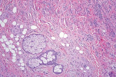 Fig. 25.46, Dermal nevus: neurotization is often accompanied by formation of typically lamellated, Meisner corpuscle-like structures.