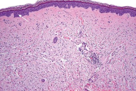 Fig. 25.48, Dermal nevus: this example has undergone extensive neurotization, making it indistinguishable from a neurofibroma. One or two residual nests of nevus cells are evident in the top-left corner of the field ( arrowed ).