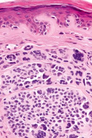 Fig. 25.49, Dermal nevus: multinucleated giant cells often with smudged chromatin are commonly found and are of no significance.