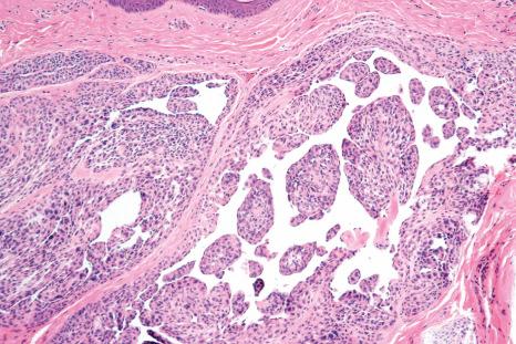 Fig. 25.50, Dermal nevus: very occasionally excessive stromal mucin deposition results in lakes. In extreme cases, this is sometimes known as a myxoid nevus.