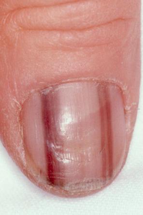 Fig. 25.5, Laugier-Hunziker syndrome: longitudinal pigmented bands in the nails.