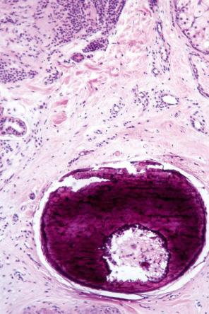 Fig. 25.52, Dermal nevus: focal calcification and even bone formation are not uncommon and usually represent a destroyed hair follicle.