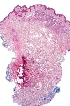 Fig. 25.53, Dermal nevus: the formation of pseudovascular spaces as shown in this example is a common artifact.