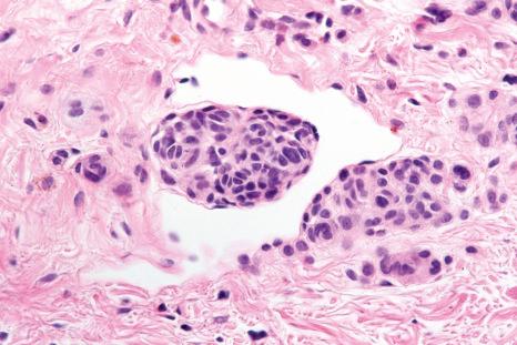 Fig. 25.55, Dermal nevus: invagination of nevus cells into the lumen of a vessel should not be confused with true vascular invasion. Distinction depends on identification of a layer of endothelial cells covering the surface of the nevoid aggregate, as shown in this example.