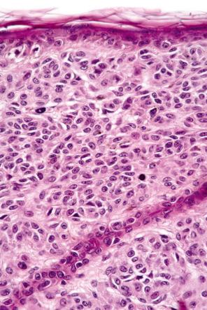 Fig. 25.56, Banal nevus: identification of one or two dermal mitotic figures is not always synonymous with melanoma. Their presence, however, should be viewed with considerable concern and other mitoses or additional features indicative of melanoma sought.