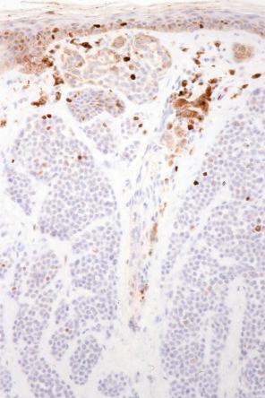 Fig. 25.59, Dermal nevus: only one or two nevus cells express MIB-1.