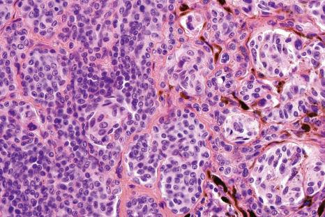 Fig. 25.63, Clonal nevus: high-power view of type A nevus cells with fine pigmentation.