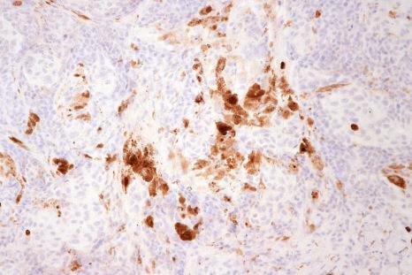 Fig. 25.64, Clonal nevus: the nevus cells do not express MIB-1.