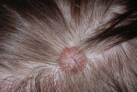 Fig. 25.65, Scalp nevus: lesions at this site may on occasions show cytological features that can raise concern for a diagnosis of melanoma by the unwary. Note the central pallor with a rim of hyperpigmentation.