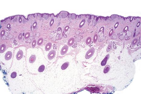 Fig. 25.66, Scalp nevus: even at low-power magnification, large expansile junctional nests can be appreciated.