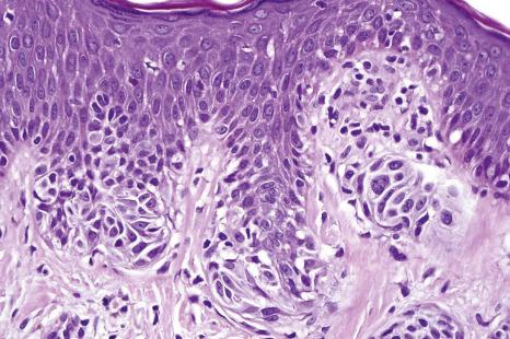 Fig. 25.68, Scalp nevus: in this field, the junctional nevus cells show moderate to severe cytological atypia.