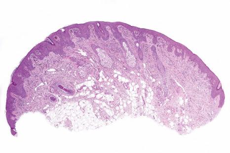 Fig. 25.72, Nevus of ear: scanning view of a largely junctional lesion.