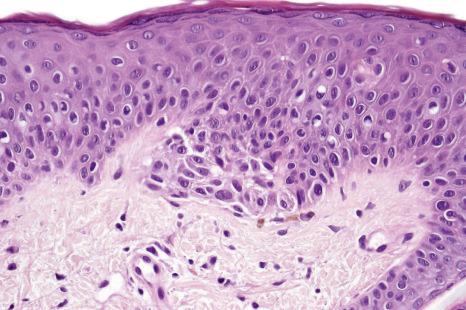 Fig. 25.73, Nevus of ear: the junctional nevus cells show severe cytological atypia.